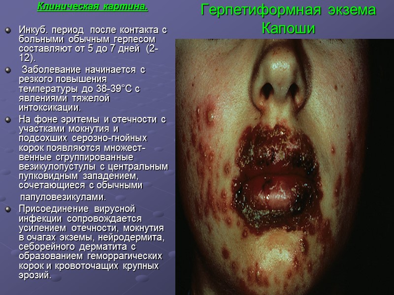 Герпетиформная экзема Капоши           